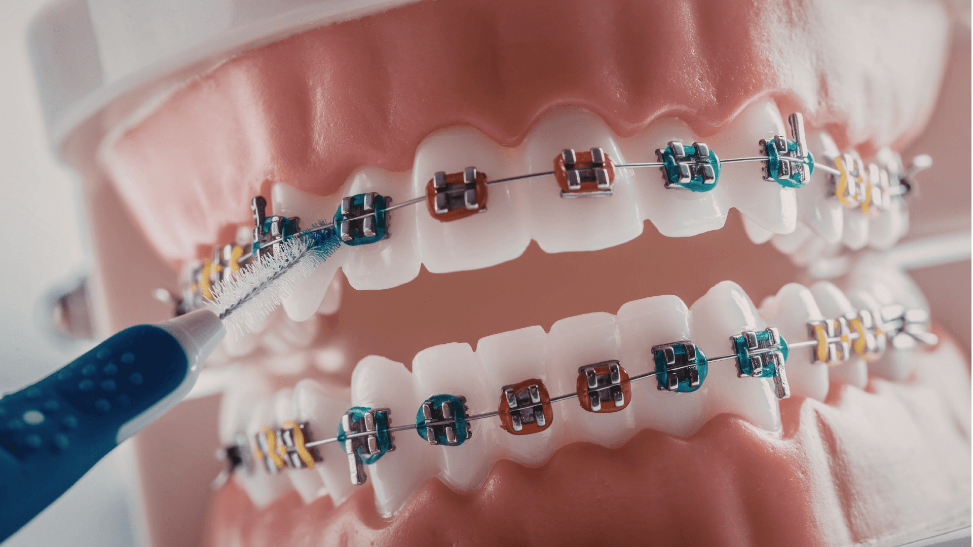 Braces & Aligners