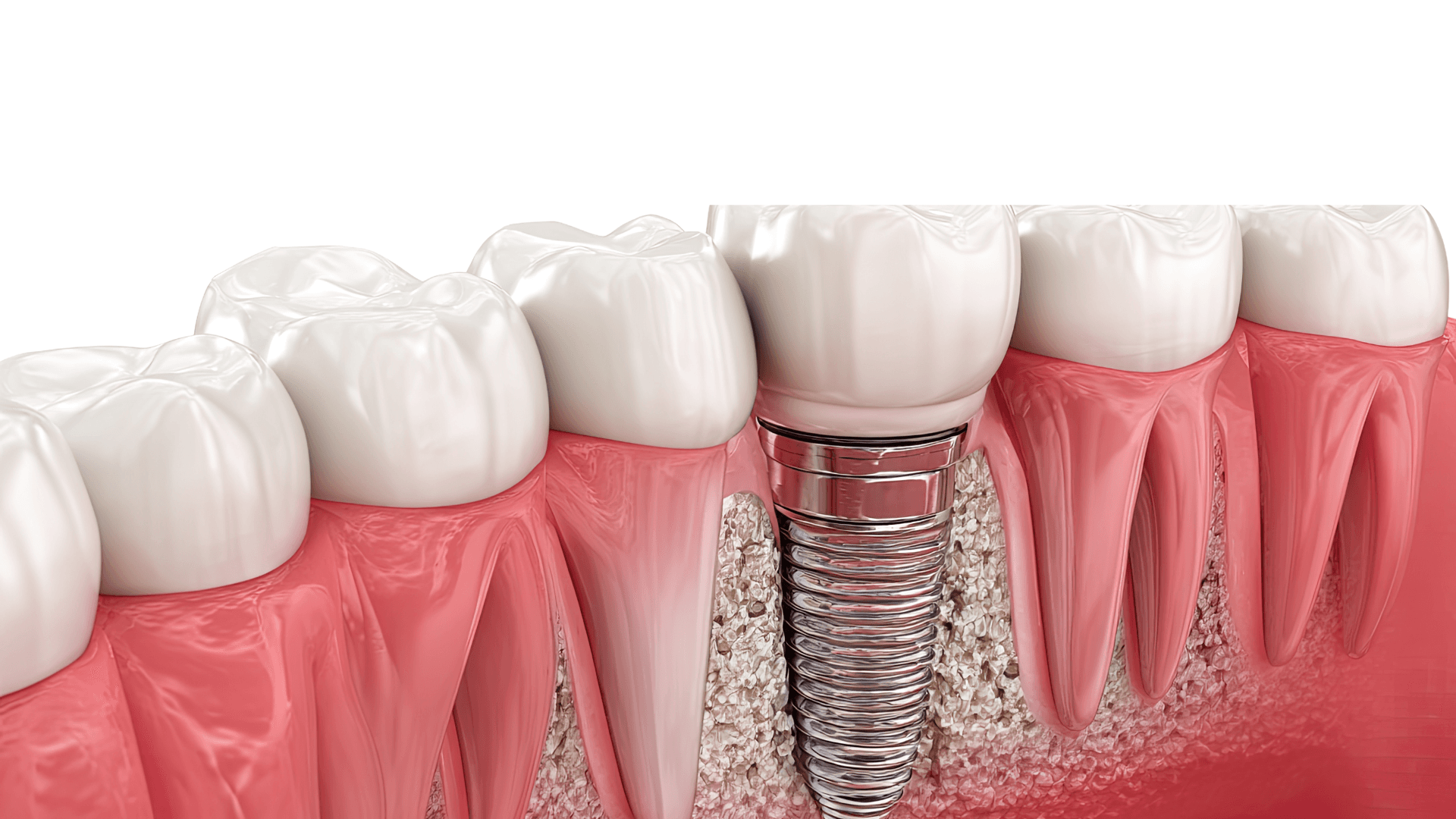 Dental Implants