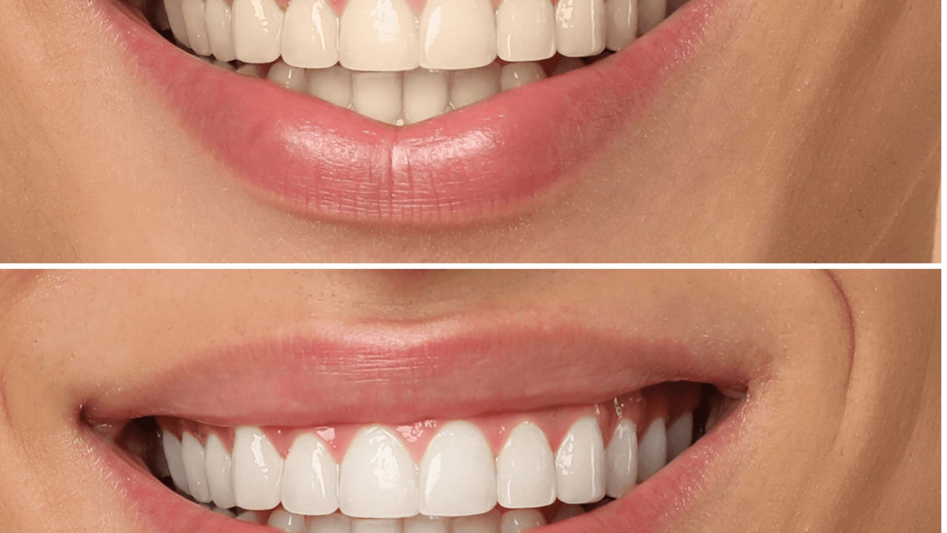 Teeth Whitening